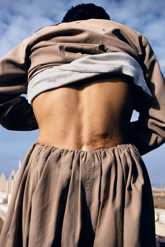 Susan Meiselas, Taymour Abdullah shows his bullet wound, Arbil, Northern Iraq, 1991. AR April 2019 Feature