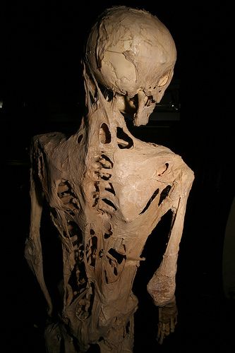 The skeleton of Harry Raymond Eastlack, a known sufferer of fibrodysplasia ossificans progressiva, a disease which causes damaged soft tissue to regrow as bone, which is housed at the Mutter Museum. Photo by Joh-co. Courtesy Wikimedia Commons